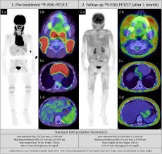 Think back to when you first met your animal companion. Iatrogenic Cushing S Syndrome On 18f Fdg Pet Ct A Pitfall In Metabolic Assessment Of Oncologic Response Clinical Imaging