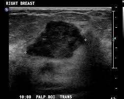 Just like computers, medical ultrasound imagers have been getting smaller and smaller. Breast Pathology Ultrasound