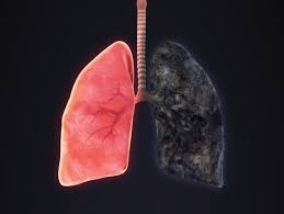 Image result for Emphysema