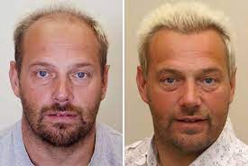 Alopecia areata (aa), a nonscarring type of hair loss, is the most prevalent autoimmune disease, with a lifetime prevalence of 1.7%. Diagnosis Of Common Hair Loss Conditions Gponline