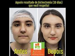 Bichectomy is a procedure that consists of the removal of buccal fat pads located in the cheeks. Aquele Resultado De Bichectomia 10 Dias Que Voce Respeita Youtube