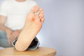 Topical vitamin a has been shown to be a successful treatment of common warts in prior informal studies. Plantar Wart Surgery Podiatrists Piedreseau