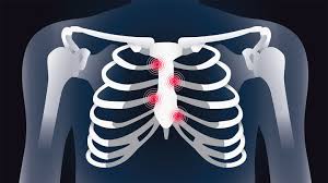 A flail chest is sometimes easier to see when the injured person is lying on his back with his shirt off. Rheumatoid Arthritis Chest And Rib Pain What Is Costochondritis Everydayhealth
