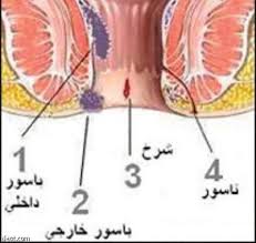 الشرخ الشرجي من عمليات اليوم الواحد والتقييم السليم ضروري جدا لسرعة تحسن الحالة صحيفة الاقتصادية