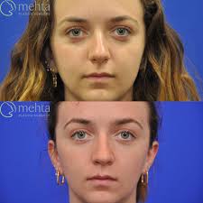 Some noses can be fixed without opening them! Today's patient wanted to  maintain her bridge and tip shape but just straighten her nose and  deproject her tip slightly. She also had a