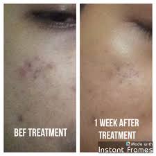 Review Rawatan Laser Muka Carbon Laser Peel Treatment