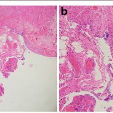 Pdf Intestinal Perforation After Nivolumab Immunotherapy For A Malignant Melanoma A Case Report