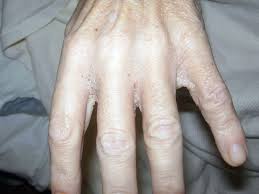 Image result for scabies on humans