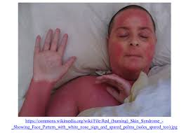 Stevens-Johnson Syndrome and Toxic Epidermal Necrolysis Mimics