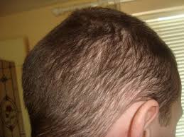 Diffuse hair loss is commonly due to telogen or anagen effluvium. So You Have Dupa Hair Loss What Are Your Options Health Nigeria