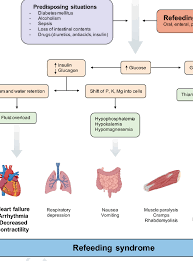 Image result for Refeeding Syndrome