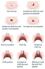 Image result for Cleft Lip
