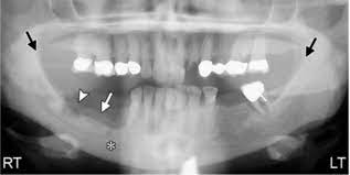 This article explains about classifications, types, risk factors, causes, symptoms, signs, investigations, treatment, prevention and complications following hip joint fracture. Cureus Medication Related Osteonecrosis Of The Jaw A Review