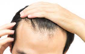The haircut creates more volume around the crown to draws attention away from your hairline. Receding Hairline Treatment Stages And Causes