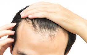 We did not find results for: Receding Hairline Treatment Stages And Causes