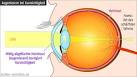 Augenlaser Lasik in Istanbul
