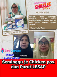 Pin On Ubat Hilangkan Parut Chicken Pox
