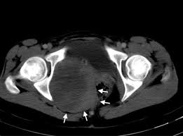 Aslı selcan çetintürk adlı kişinin profilinde 5 iş ilanı bulunuyor. A Rare Diagnosis In A Patient With Pelvic Pain Adnexal Schwannoma Bentham Science