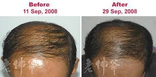 Sebum buildup and hair loss are connected by the hormone dht (3). Sg Oily Treatment For Hair Loss Natural Hair Care Tips