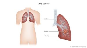 Image result for Lung Cancer