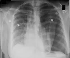 We did not find results for: Mantelpneumothorax