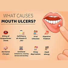Image result for Mouth ulcers symptoms roof of the mouth