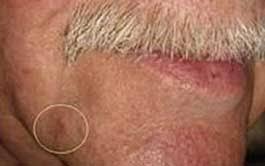 22.01.2021 · 4 most common types of skin cancer. Skin Cancer Pariser Dermatology
