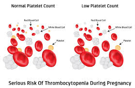 Thrombocytopenia Low Platelets In Pregnancy Causes Risks