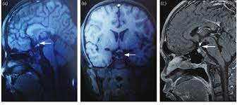 Typical Features Of Pituitary Stalk Interruption Syndrome On Magnetic Download Scientific Diagram