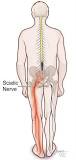 Image result for icd 10 code for sciatica of left side
