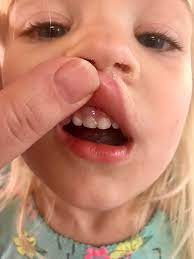 Gray Tooth Dentist April 2016 Babies Forums What To Expect