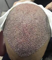 We Completed One More Hair Transplant Operation Hair Implants Hair Transplant Fue Hair Transplant