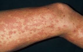 Therefore, the fast way on how to get rid of cramps in feet, legs, hands, and stomach is to rehydrate your body, which will solve the problem quickly. How Urticaria Or Hives Are Treated