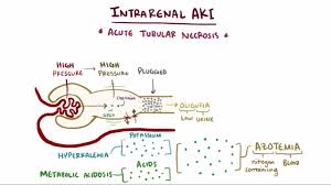 Acute Kidney Injury Aki Kidney And Urinary Tract