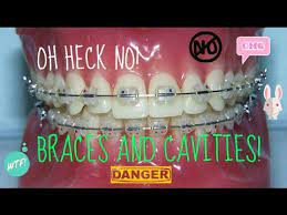 These are all good questions and your orthodontist, dr. Braces And Cavities Youtube