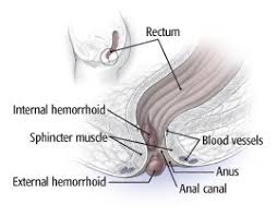 Image result for hemorrhoids