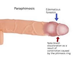 Image result for Phimosis