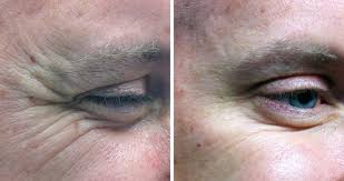 While you don't need to maintain the intensity of the first four weeks forever on your quest for abs, you do still need to work hard. Crow S Feet Treatment With Botox Dysport Auckland Beautiphi
