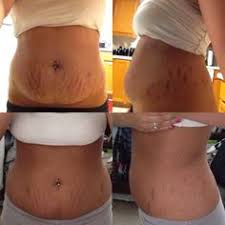 Vicks Vapor Rub Uses For Stretch Marks Mentholatum