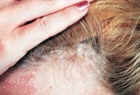 Image result for white scabs on the head in children
