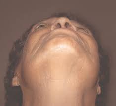 Image result for Proptosis