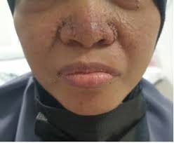 Bilateral Giant Renal Angiomyolipoma in Tuberous Sclerosis Complex with  Wunderlich Syndrome: A Case Report