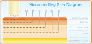 microneedling pen designed for patient safety and comfort in