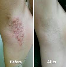 Ingrown hair is more common in women who have curly hair. 25 Products That Ll Succeed Where All Others Have Failed
