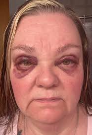 Concern about bruise and potential clot after doctor's appointment