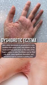 Image result for dyshidrosis