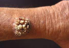 A red or dark patch. Warts American Skin Association