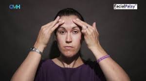 Bell's palsy is when one side of the face becomes weak or paralyzed. Neuromuscular Reeducation In Facial Palsy Physiopedia