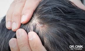 Image result for white scabs on the head in children