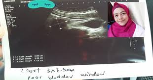 Kebiasaannya cyst ni tidak menunjukkan sebarang tanda,sebab itu ia jarang di kesan awal pada ibu hamil, cyst di kesan secara tidak sengaja oleh doktor pada trimester pertama kehamilan. Tanda Cyst Berulang Nonspeculation Freeride Site